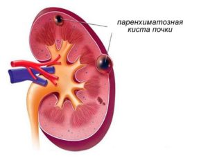 Киста на левой почке какое лечение