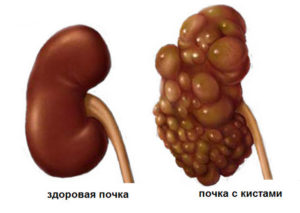 Киста на почке у ребенка 6 лет