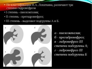 Классификация гидронефроза по степени