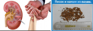Когда выходит песок с почек симптомы