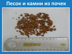 Когда выходит песок с почек симптомы