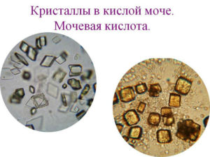 Кристаллы в моче повышены у ребенка