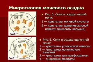 Кристаллы в моче повышены у ребенка