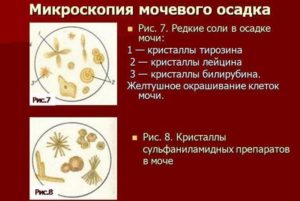 Кристаллы в моче повышены у ребенка
