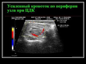 Кровоток при цдк не определяется