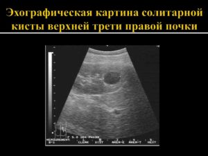Мелкая киста паренхимы почки