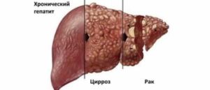 Метастазы 4 степени