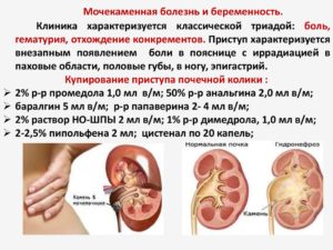 Мочекаменная болезнь при беременности последствия для ребенка