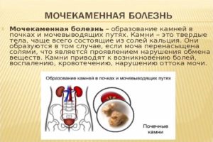 Можно ли при мочекаменной болезни