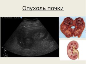 Нарост на почке что это