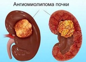 Нарост на почке что это