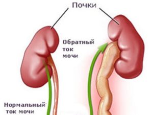 Нарушение оттока мочи из почки лечение