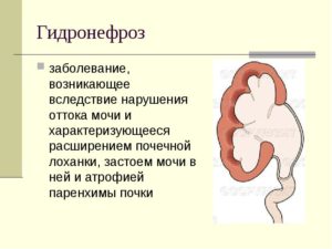 Нарушение оттока мочи из почки лечение