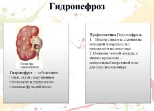 Нарушение оттока мочи из почки лечение