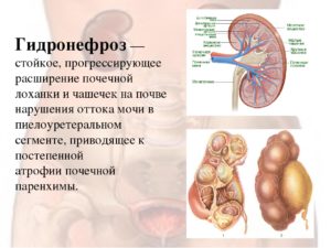 Нарушение оттока мочи из почки лечение