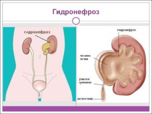 Нарушение оттока мочи из почки лечение