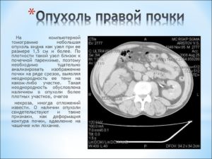 Признаки образования правой почки