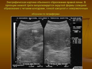 Признаки образования правой почки