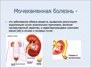 Профилактика и лечение мочекаменной болезни у мужчин