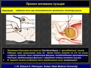 Прокол мочевого пузыря