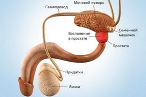 Противопоказания при простатите у мужчин