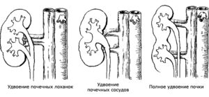 Удвоение почек члс