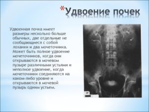 Удвоение почек члс