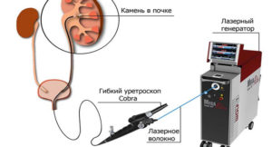 Удаление камней из почек лазером владивосток