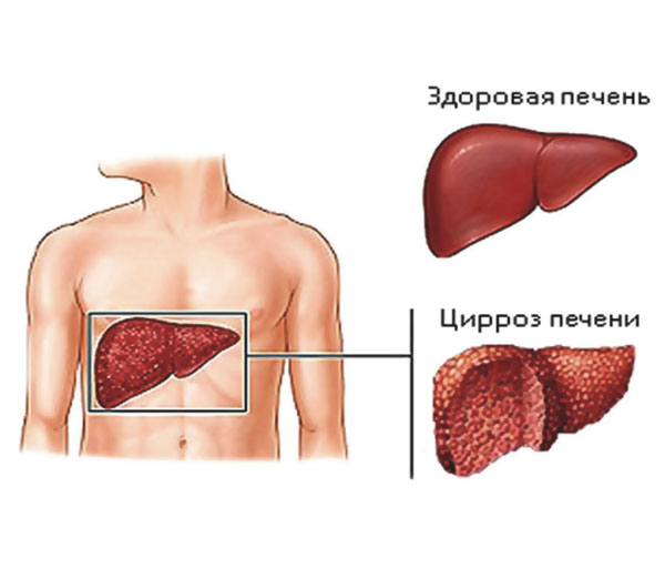 Цирроз