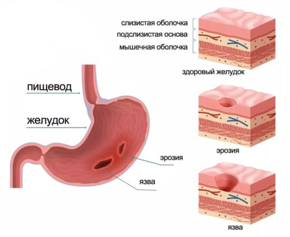 Эрозия