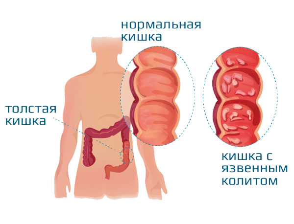 Колит