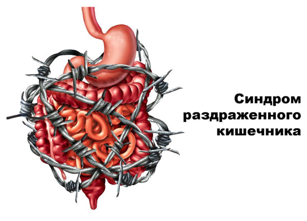 Синдром раздраженного кишечника