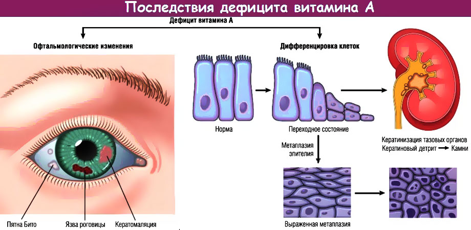 Дефицит витамина А 