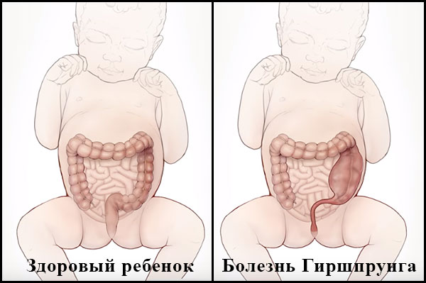 Два изображения грудных детей с видимыми кишечниками: первый ребенок здоров, второй с болезнью Гиршпрунга